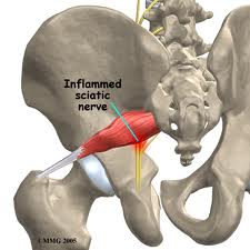 Piriformis Syndrome low back pain 