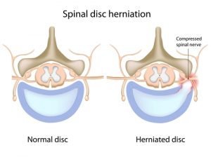 Different Types of Low Back Pain - Peak Form Health Center